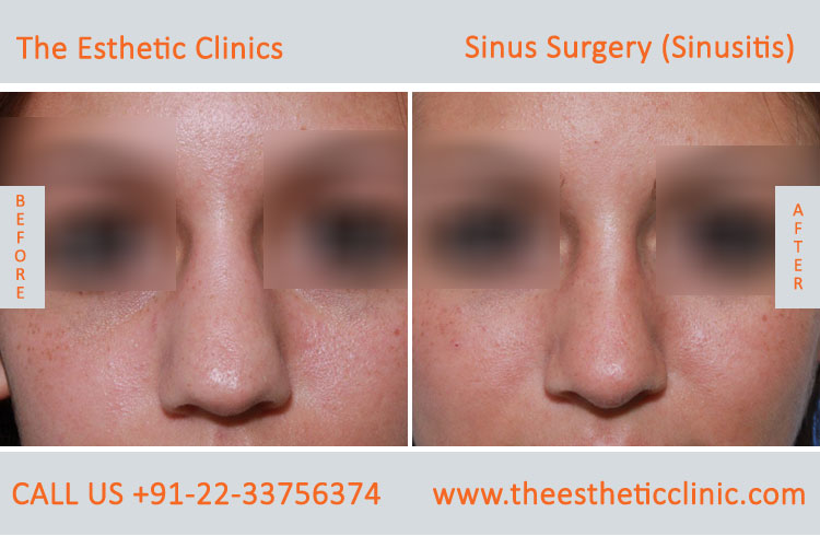 Sinus Surgery, Sinusitis before after photos in mumbai india (6)